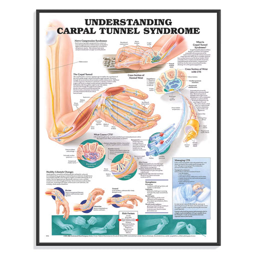 Understanding Carpal Tunnel Syndrome chart