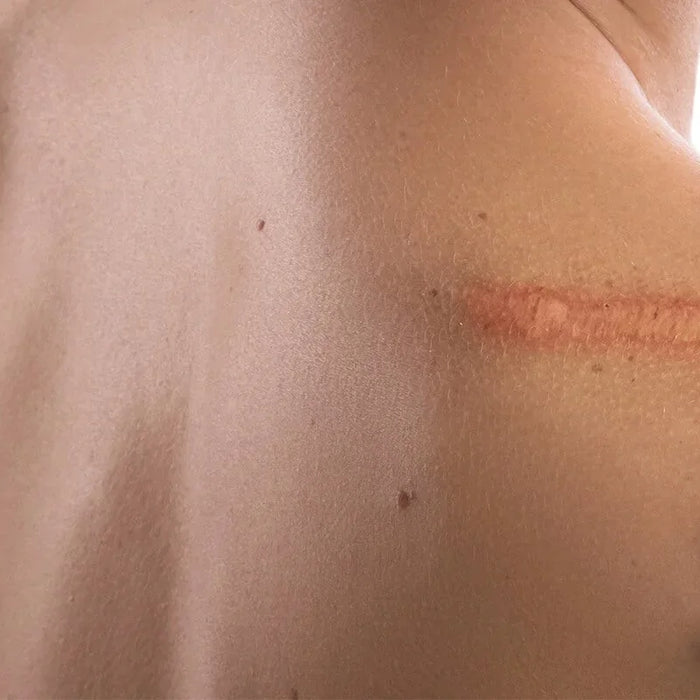 Bodybest Techniques for Addressing Scar Tissue