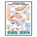 Understanding Carpal Tunnel Syndrome chart