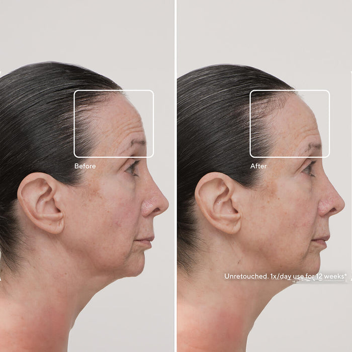 Before and after treatment with the Thera Face Mask