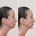 Before and after treatment with the Thera Face Mask